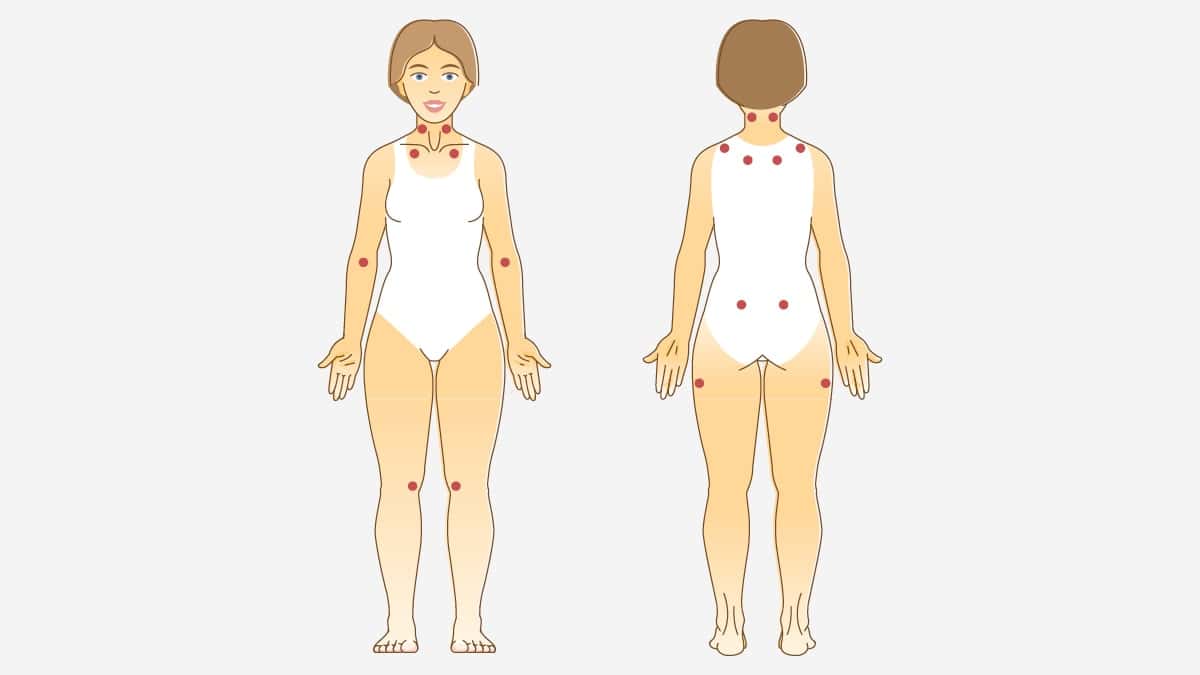 230403 Wdg Fibromyalgie 10