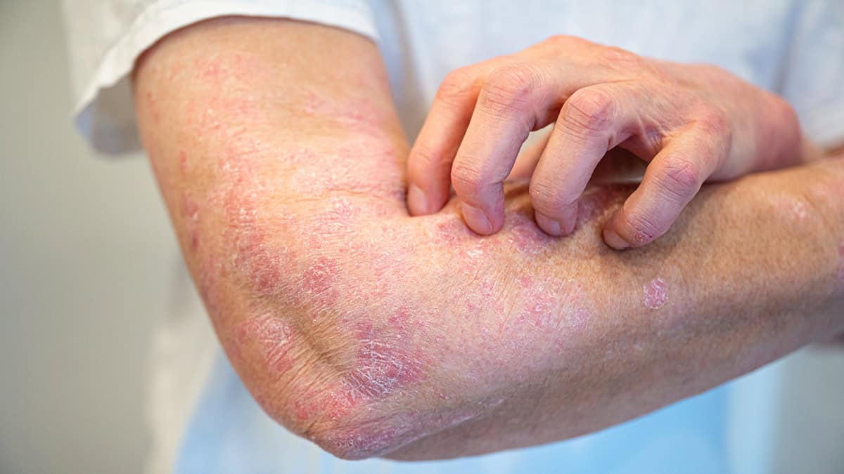230403 Wdg Psoriasis 7
